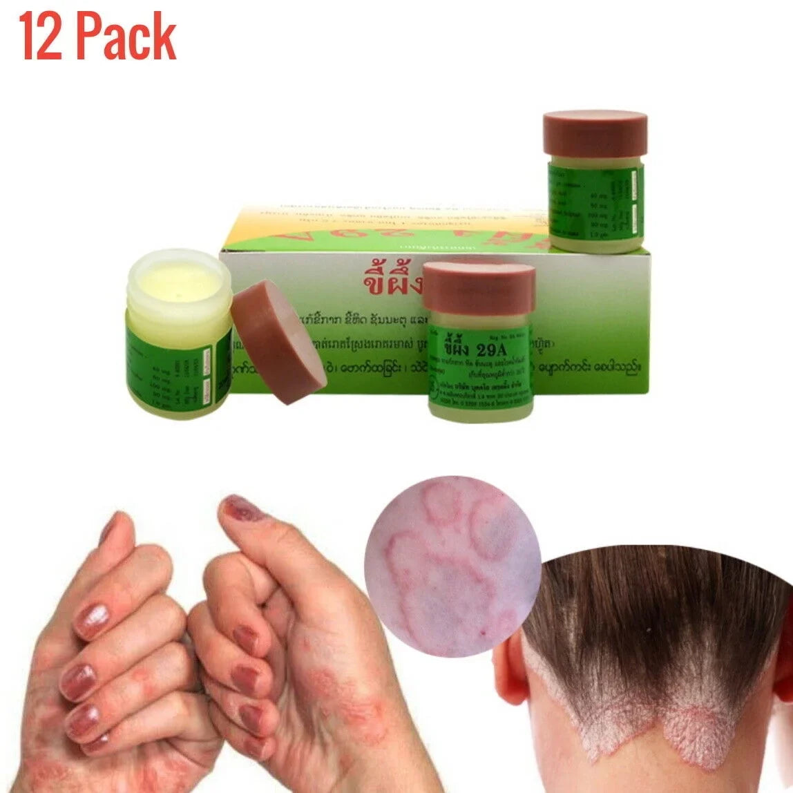 Sca[b]ies - [] ock Itch - []ingworm - Athletes Ft. - Herp. - Fast Support Herbal Natural Cream -   Itch Relief - Natural []intment -  12 Jars